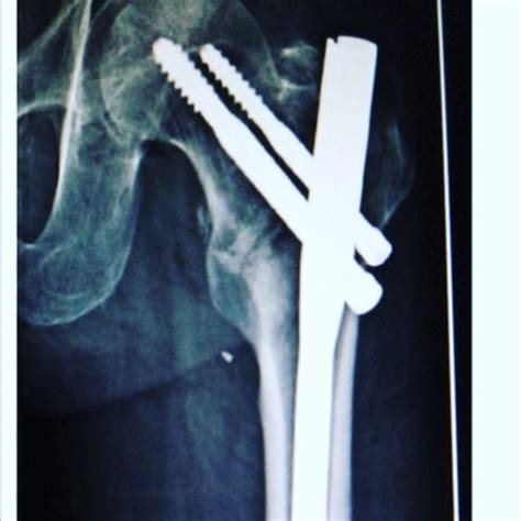 titanium rod|titanium rod in leg surgery.